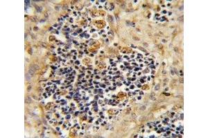IHC analysis of FFPE human kidney carcionma stained with ROR2 antibody