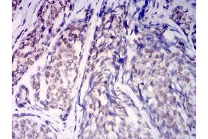 Immunohistochemical analysis of paraffin-embedded esophageal cancer tissues using KDM1A mouse mAb with DAB staining. (LSD1 anticorps  (AA 709-876))