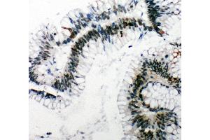 Anti-53BP1 antibody, IHC(P) IHC(P): Human Intestinal Cancer Tissue