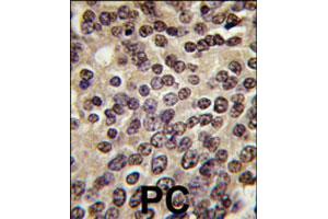 Formalin-fixed and paraffin-embedded human prostate carcinoma tissue reacted with PKN3 polyclonal antibody  , which was peroxidase-conjugated to the secondary antibody, followed by DAB staining. (PKN3 anticorps  (C-Term))