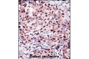 TERF2IP Antibody (C-term) ((ABIN657968 and ABIN2846914))immunohistochemistry analysis in formalin fixed and paraffin embedded human breast carcinoma followed by peroxidase conjugation of the secondary antibody and DAB staining. (RAP1 anticorps  (C-Term))