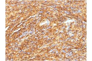 Formalin-fixed, paraffin-embedded human GIST stained with DOG-1 Mouse Monoclonal Antibody (DG1/1484).