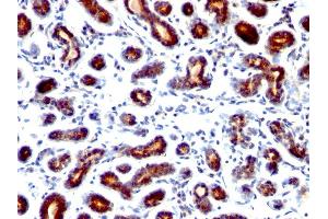 Formalin-fixed, paraffin-embedded human breast Carcinoma stained with pS2 Monoclonal Antibody (TFF1/1091).
