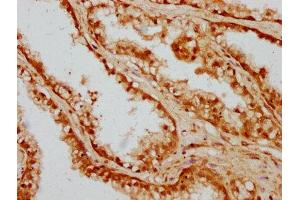 IHC image of ABIN7148764 diluted at 1:300 and staining in paraffin-embedded human prostate cancer performed on a Leica BondTM system.
