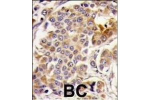 Formalin-fixed and paraffin-embedded human breast carcinoma tissue reacted with PRKp, which was peroxidase-conjugated to the secondary antibody, followed by DAB staining. (AMPK alpha anticorps  (AA 474-502))