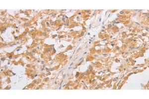 Immunohistochemistry of paraffin-embedded Human thyroid cancer tissue using CDKN2AIP Polyclonal Antibody at dilution 1:40 (CDKN2AIP anticorps)