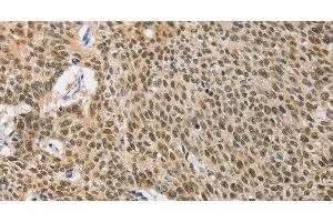 Immunohistochemistry of paraffin-embedded Human lung cancer using HSP40 Polyclonal Antibody at dilution of 1:40
