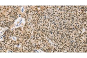 Immunohistochemistry of paraffin-embedded Human lung cancer using HSP40 Polyclonal Antibody at dilution of 1:40 (DNAJB1 anticorps)