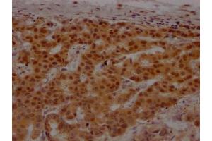 IHC image of ABIN7127667 diluted at 1:100 and staining in paraffin-embedded human breast cancer performed on a Leica BondTM system.