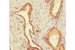Immunohistochemistry of paraffin-embedded human prostate cancer using ABIN7174476 at dilution of 1:100 (UBE2Q2 anticorps  (AA 1-375))