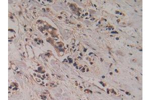 IHC-P analysis of CHuman Breast Cancer Tissue, with DAB staining. (CKMT1A anticorps  (AA 41-250))