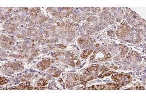 ABIN6272296 at 1/100 staining Human liver cancer tissue by IHC-P. (ELTD1 anticorps  (Internal Region))