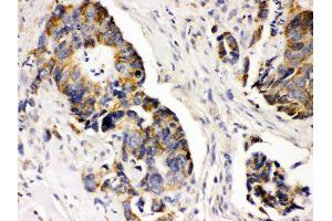 Anti- PDGFRA Picoband antibody, IHC(P) IHC(P): Human Intestinal Cancer Tissue (PDGFRA anticorps  (C-Term))