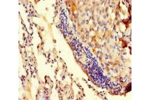 Immunohistochemistry of paraffin-embedded human lung cancer using ABIN7173512 at dilution of 1:100 (TRMT112 anticorps  (AA 1-125))
