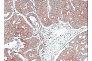 IHC-P Image Immunohistochemical analysis of paraffin-embedded Gastric CA N87 xenograft, using MPI, antibody at 1:100 dilution. (MPI anticorps)