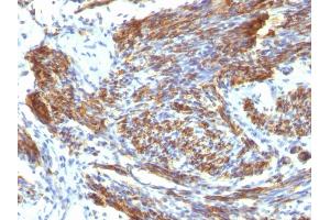Formalin-fixed, paraffin-embedded human Leiomyosarcoma stained with Caldesmon Mouse Monoclonal Antibody (CALD1/820). (Caldesmon anticorps)
