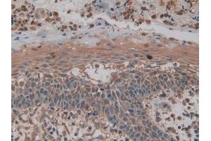 Detection of PKM2 in Human Skin cancer Tissue using Polyclonal Antibody to Pyruvate kinase isozymes M2 (PKM2)