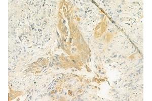 ABIN6261506 and ABIN6272997 at 1/100 staining human lung squamous cell carcinoma by IHC-P. (ELAC2 anticorps  (N-Term))