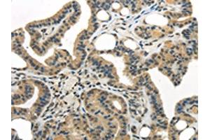 The image on the left is immunohistochemistry of paraffin-embedded Human thyroid cancer tissue using ABIN7193040(WDR36 Antibody) at dilution 1/35, on the right is treated with synthetic peptide. (WDR36 anticorps)