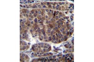 PRAMEF3 Antibody (C-term) immunohistochemistry analysis in formalin fixed and paraffin embedded human melanoma followed by peroxidase conjugation of the secondary antibody and DAB staining. (PRAMEF3 anticorps  (C-Term))
