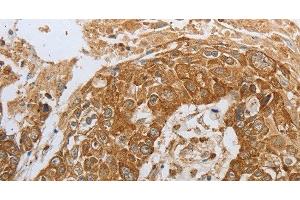 Immunohistochemistry of paraffin-embedded Human esophagus cancer using CKM Polyclonal Antibody at dilution of 1:50 (CKM anticorps)