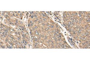 Immunohistochemistry of paraffin-embedded Human liver cancer tissue using C17orf67 Polyclonal Antibody at dilution of 1:50(x200) (C17ORF67 anticorps)