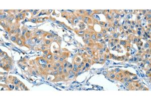 Immunohistochemistry of paraffin-embedded Human lung cancer tissue using SERPINA3 Polyclonal Antibody at dilution 1:55
