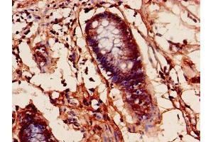Immunohistochemistry of paraffin-embedded human colon cancer using ABIN7164206 at dilution of 1:100 (PFDN1 anticorps  (AA 2-122))