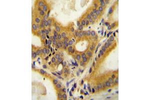 CC85C Antibody (N-term) (ABIN654469 and ABIN2844203) immunohistochemistry analysis in formalin fixed and paraffin embedded human prostate carcinoma followed by peroxidase conjugation of the secondary antibody and DAB staining. (CCDC85C anticorps  (N-Term))