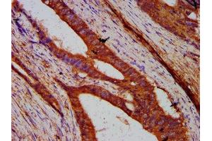 IHC image of ABIN7170975 diluted at 1:200 and staining in paraffin-embedded human colon cancer performed on a Leica BondTM system. (SUN2 anticorps  (AA 45-155))