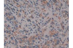 Detection of CD109 in Human Prostate cancer Tissue using Polyclonal Antibody to Cluster Of Differentiation 109 (CD109)