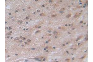 Detection of NOTCH4 in Human Glioma Tissue using Polyclonal Antibody to Notch Homolog 4 (NOTCH4)