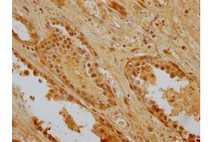 IHC image of ABIN7154883 diluted at 1:256 and staining in paraffin-embedded human prostate cancer performed on a Leica BondTM system.