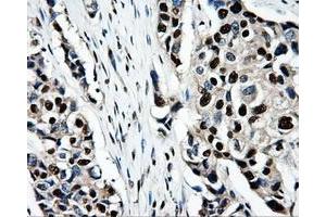 Immunohistochemical staining of paraffin-embedded Adenocarcinoma of ovary tissue using anti-PSMC3mouse monoclonal antibody.