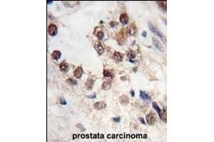 Formalin-fixed and paraffin-embedded human prostata carcinoma tissue reacted with KLF4 antibody (N-term C74) (ABIN389187 and ABIN2839350) , which was peroxidase-conjugated to the secondary antibody, followed by DAB staining. (KLF4 anticorps  (AA 69-101))