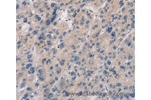 Immunohistochemistry of Human liver cancer using IMPDH1 Polyclonal Antibody at dilution of 1:20 (IMPDH1 anticorps)