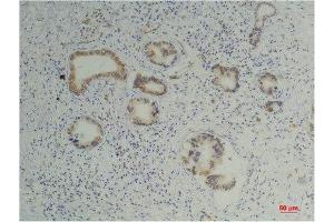 Immunohistochemistry (IHC) analysis of paraffin-embedded Human Pancreatic Carcinoma using Cyclophilin B Mouse Monoclonal Antibody diluted at 1:200.