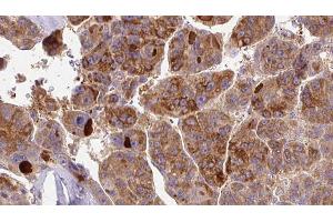 ABIN6273395 at 1/100 staining Human liver cancer tissue by IHC-P. (SCN3A anticorps  (Internal Region))
