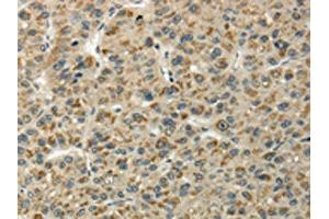 The image on the left is immunohistochemistry of paraffin-embedded Human liver cancer tissue using ABIN7128060(UBL4B Antibody) at dilution 1/25, on the right is treated with fusion protein. (UBL4B anticorps)