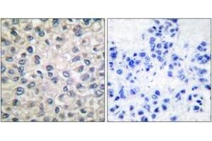 Immunohistochemistry analysis of paraffin-embedded human breast carcinoma tissue, using Catenin-alpha1 Antibody.