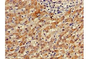 Immunohistochemistry of paraffin-embedded human liver cancer using ABIN7153223 at dilution of 1:100 (FUOM anticorps  (AA 1-134))