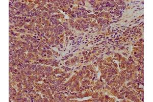 IHC image of ABIN7158034 diluted at 1:200 and staining in paraffin-embedded human lung cancer performed on a Leica BondTM system.