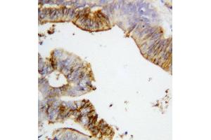 Anti-Annexin A2 antibody, IHC(P) IHC(P): Human Intestinal Cancer Tissue (Annexin A2 anticorps  (Middle Region))