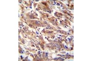 Immunohistochemistry analysis in formalin fixed and paraffin embedded human breast carcinoma reacted with FBXW12 Antibody (C-term) followed by peroxidase conjugation of the secondary antibody and DAB staining.