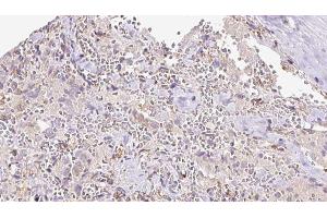 ABIN6273308 at 1/100 staining Human thyroid cancer tissue by IHC-P. (REEP6 anticorps  (C-Term))