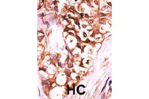 Formalin-fixed and paraffin-embedded human hepatocellular carcinoma tissue reacted with DUSP8 polyclonal antibody  , which was peroxidase-conjugated to the secondary antibody, followed by AEC staining. (DUSP8 anticorps  (C-Term))
