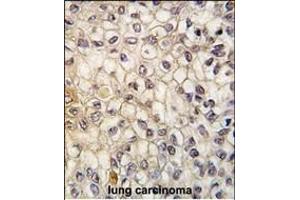 Formalin-fixed and paraffin-embedded human lung carcinoma tissue reacted with CYP2F1 antibody (C-term), which was peroxidase-conjugated to the secondary antibody, followed by DAB staining.