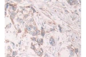 Detection of Grb10 in Human Prostate cancer Tissue using Polyclonal Antibody to Growth Factor Receptor Bound Protein 10 (Grb10)