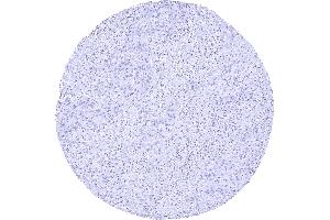 Pancreas with a CA19 9 negative acinar cell carcinoma