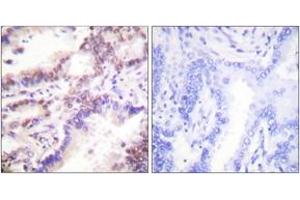 Immunohistochemistry analysis of paraffin-embedded human lung carcinoma tissue, using CTIP (Ab-327) Antibody. (Retinoblastoma Binding Protein 8 anticorps  (AA 293-342))